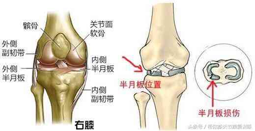 膝关节半月板磨损：工作原因导致的损伤能否被认定为工伤？