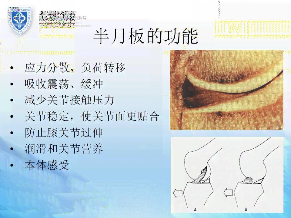 半月板磨损的不可逆性及其综合应对策略解析