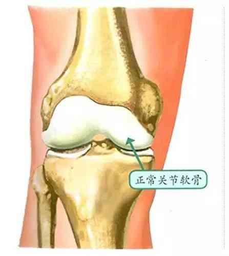 半月板磨损的不可逆性及其综合应对策略解析