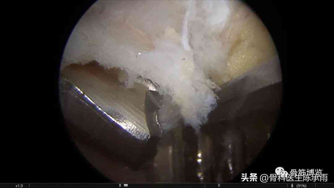 单位肩锁脱位工伤认定标准与赔偿流程解析