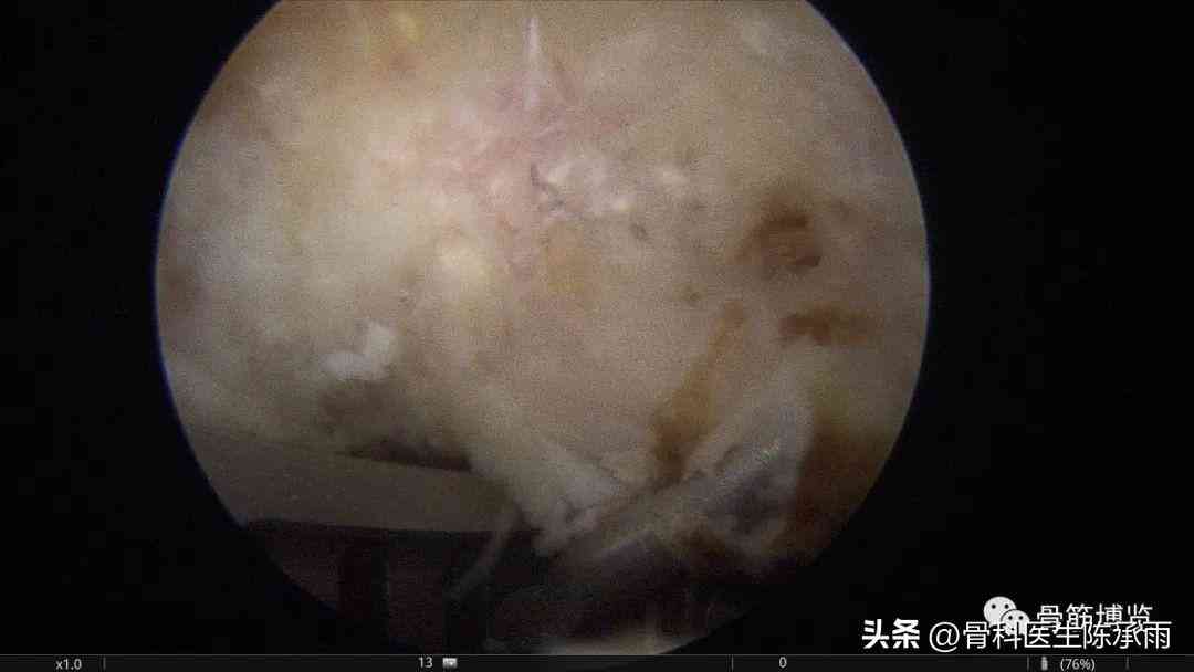 单位肩锁脱位工伤认定标准与赔偿流程解析