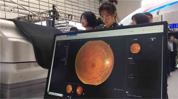 AI驱动的眼底照相机：深度解析智能诊断报告的奥秘
