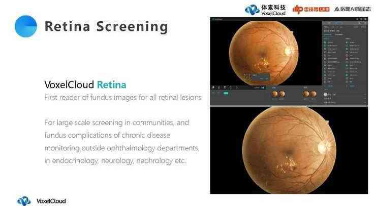 深入解读AI眼底照相机报告：全面指南教你如何准确解析眼部健信息