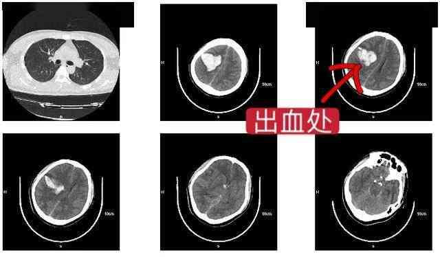 下班高峰期工人餐厅内突发脑出血意外