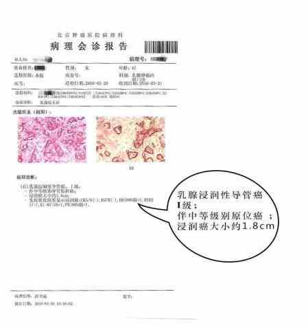 癌病理报告(-)癌症与癌变病理学意义解析