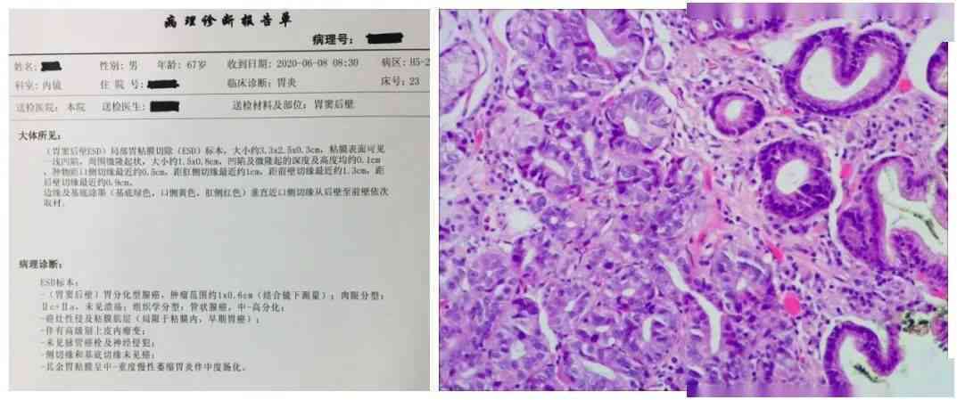 癌病理报告(-)癌症与癌变病理学意义解析