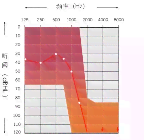 听力损失30分是否算作聋：深入了解听力阈值与耳聋标准