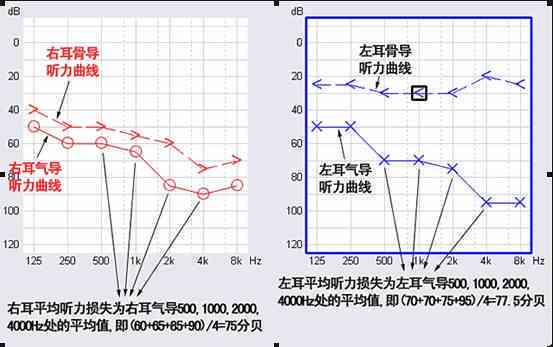 听力损失30分是否算作聋：深入了解听力阈值与耳聋标准