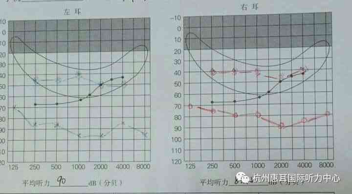 30分双耳听力检测结果是否属于正常范围