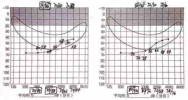 双耳听力30分：评估听力损失程度及其影响
