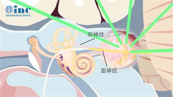 听神经瘤可以认定工伤吗