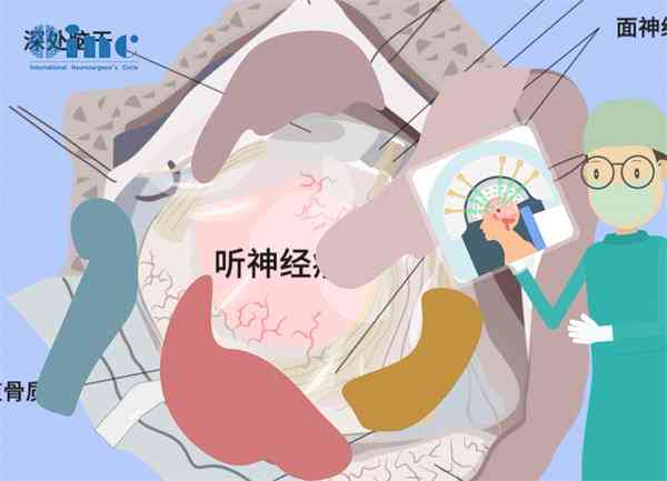 听神经瘤可以认定工伤吗