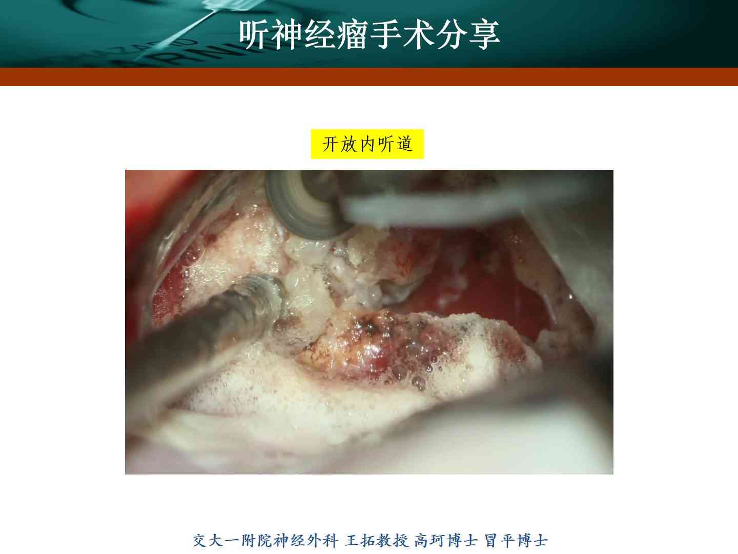 听神经瘤可以认定工伤吗