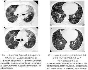 吸入性属于意外、院内感染、间质性或小叶性吗？