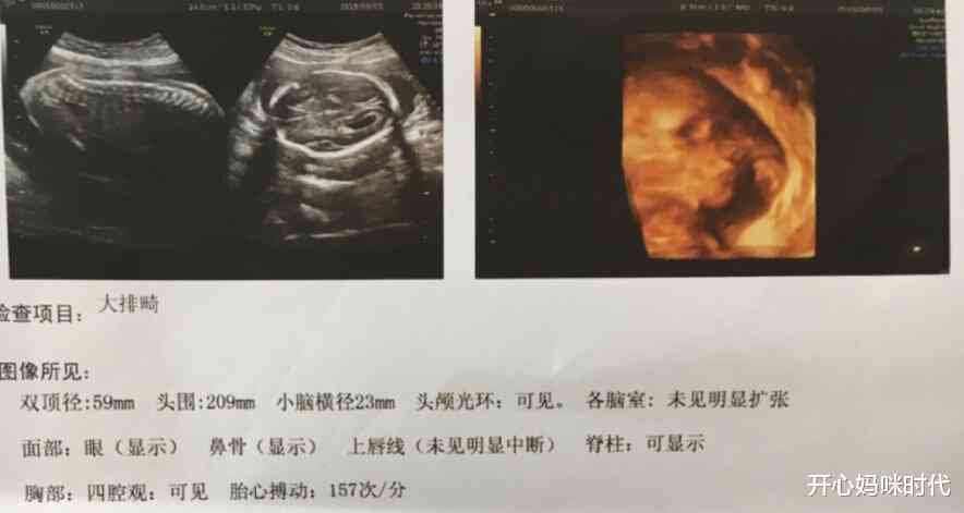 彩超报告中的AC含义及胎儿发育情况综合解读