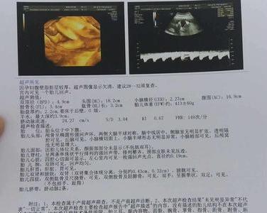 彩超报告中的AC含义及胎儿发育情况综合解读