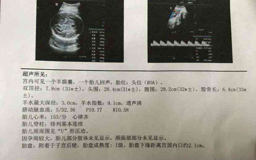 彩超报告中的AC含义及胎儿发育情况综合解读