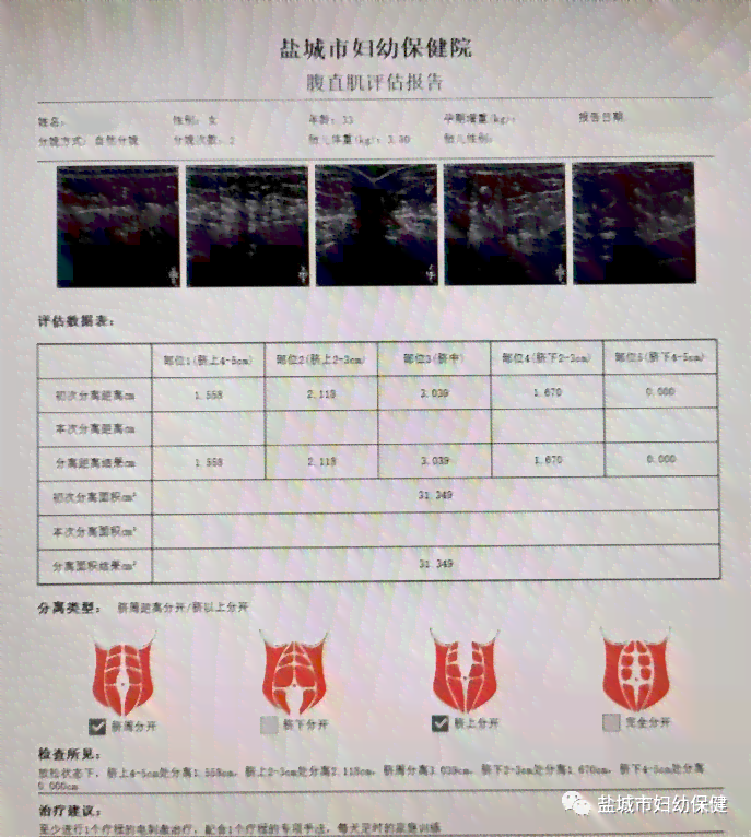 彩超报告AO：如何解读AC含义、查看报告单及等待结果时长