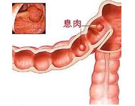 咽喉息肉是否会恶变：探讨其癌变风险与预防策略
