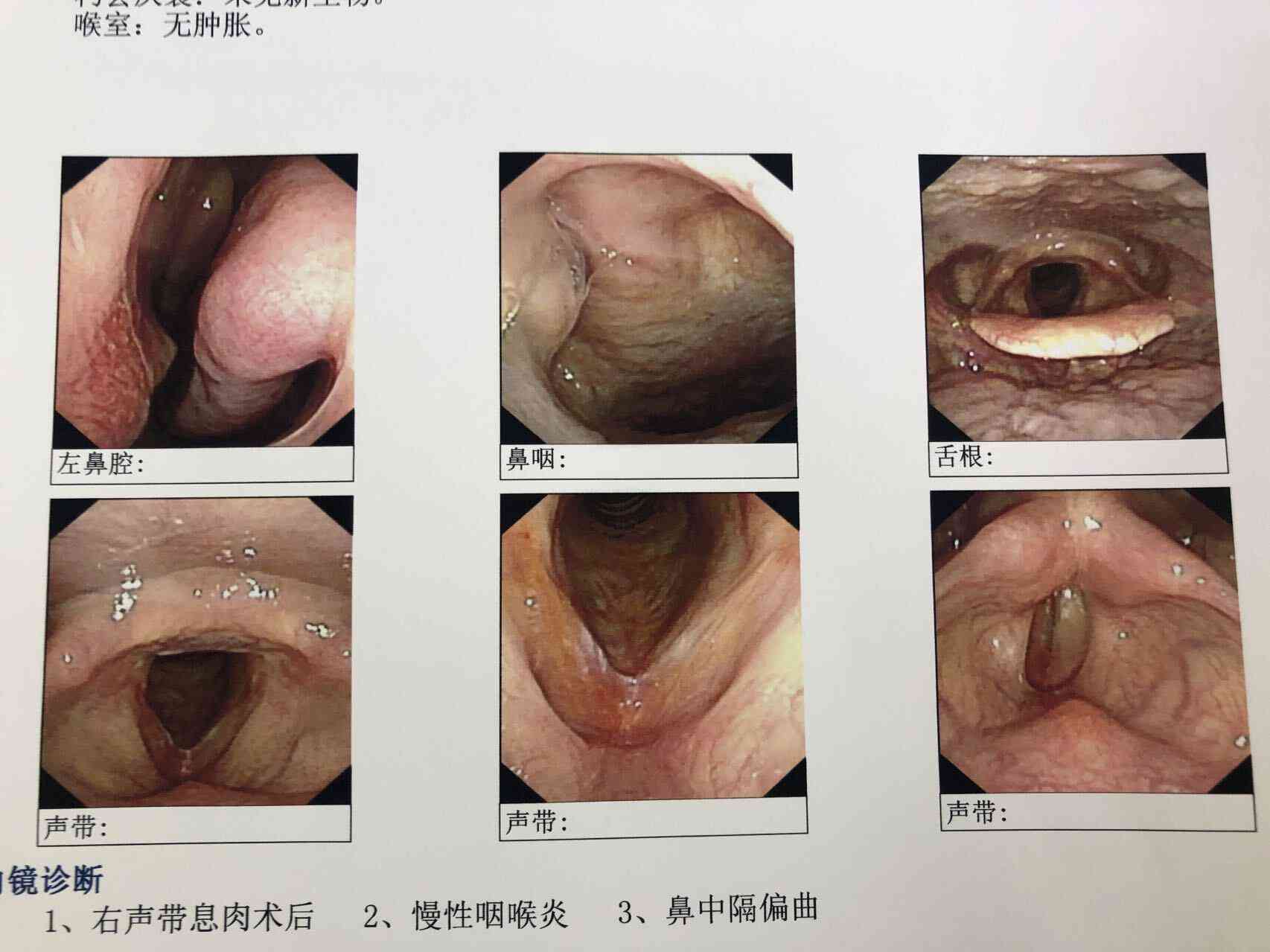 咽喉息肉能认定工伤吗