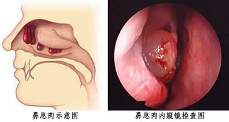 咽喉息肉能认定工伤吗