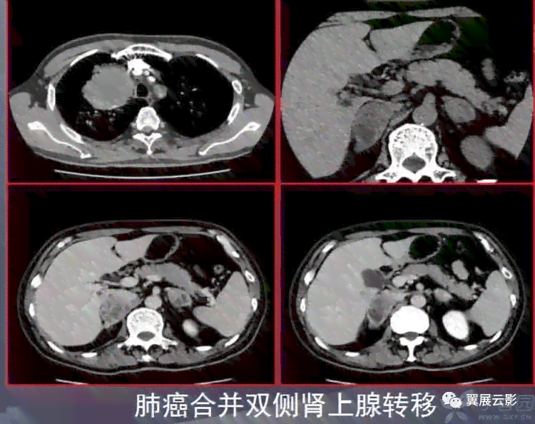 囊肿算职业病吗：探讨囊肿病变、业障病及入职影响