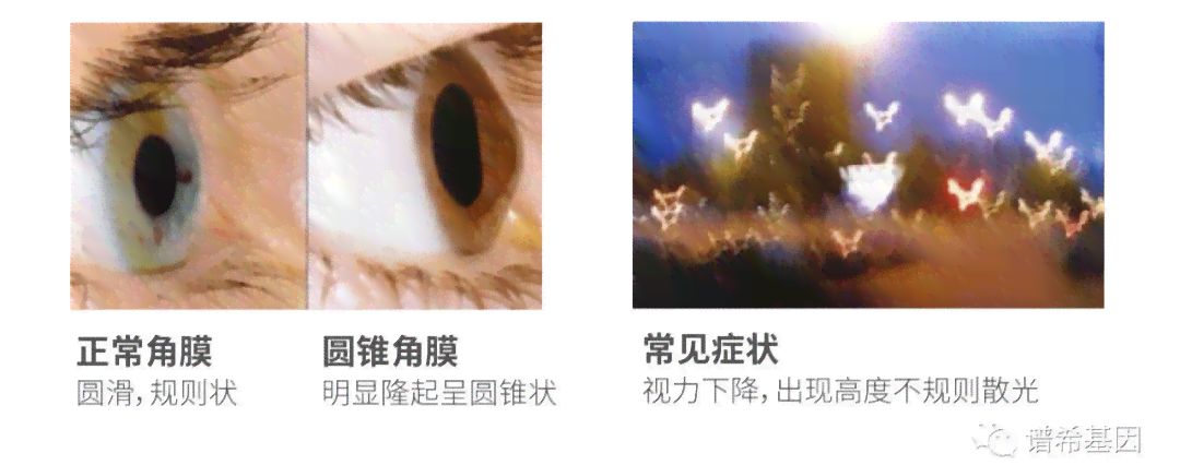 全面解析圆锥角膜：治疗现状、改善可能性与未来展望