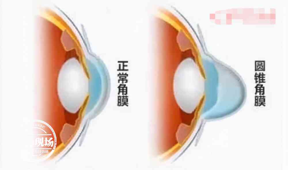 圆锥角膜可以上班工作吗：对职业生涯及夜班工作的影响与注意事项