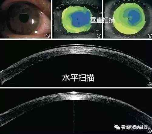 圆锥角膜：了解其危害与潜在风险