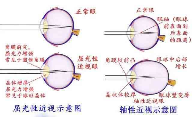 圆锥角膜：了解其危害与潜在风险