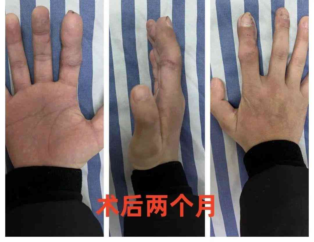 工伤十级鉴定赔偿全流程解析：涵补助金、就业金及法律     指南