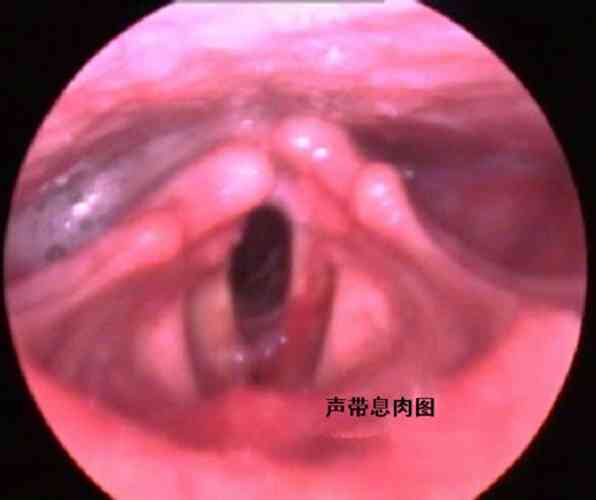 声带息肉：工伤认定的标准、流程与相关权益详解