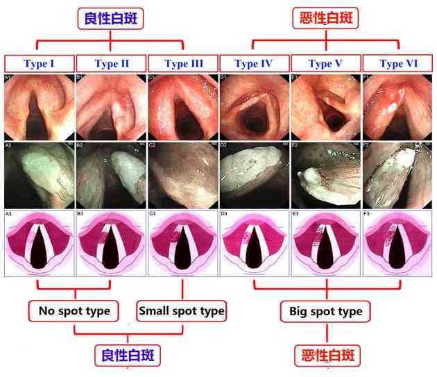 声带白斑认定工伤：其严重性、致命性、发病率及对寿命影响与手术必要性解析