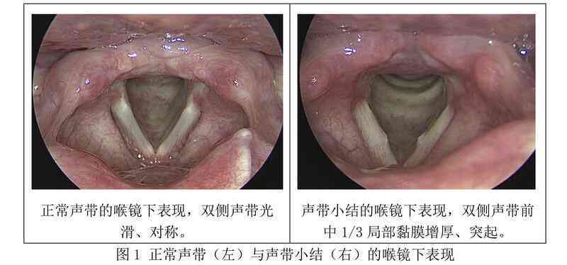 声带小结确诊为职业性疾病：工伤认定的可能性探讨