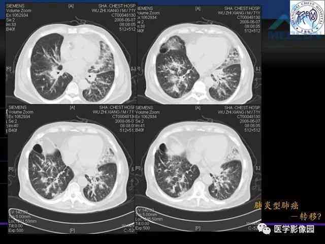声带结节治疗方式详探：手术疗法与非手术疗法全面解析