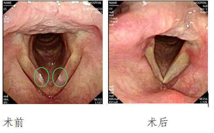 声带结节要动手术吗：治疗费用、手术方法、自愈可能性解析