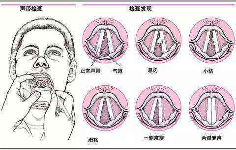 声带结节：了解其危害、成因、症状及治疗对策