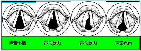 声带结节会自己消退吗：治疗、吃什么药、能否自愈及好转方法