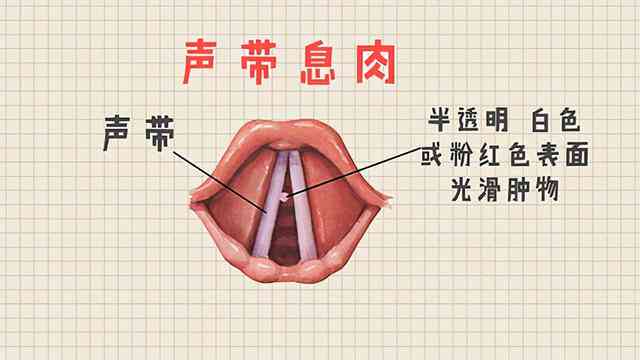 声带结节会自己消退吗：治疗、吃什么药、能否自愈及好转方法