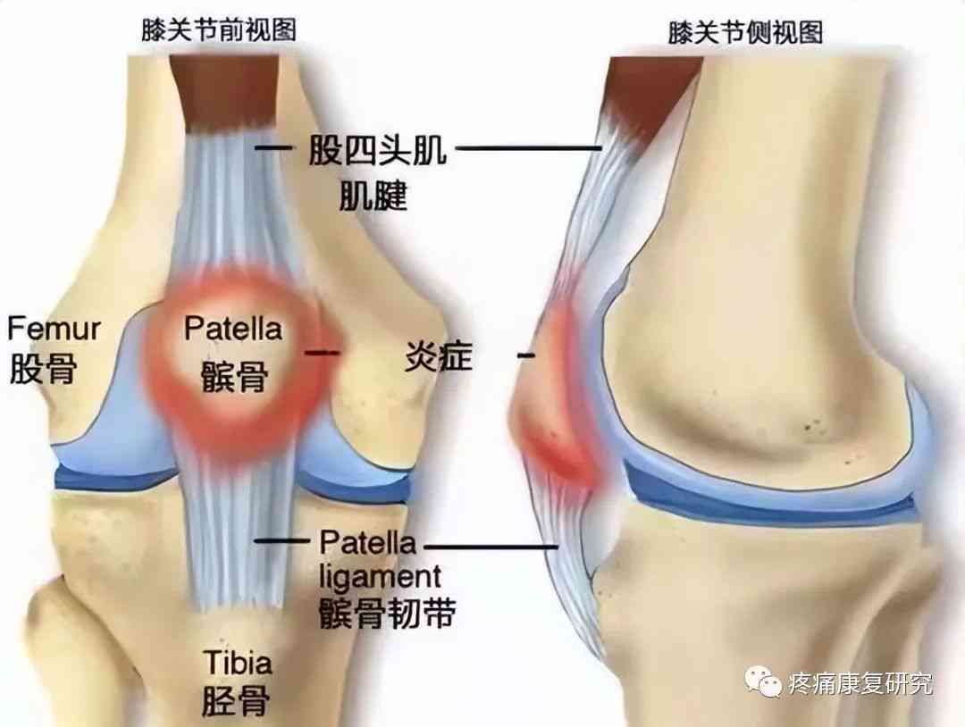 复发性髌骨脱位能算工伤吗：工伤认定、症状、体征及不手术后果分析