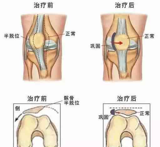 复发性髌骨脱位能算工伤吗：工伤认定、症状、体征及不手术后果分析