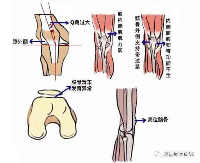 复发性髌骨脱位能算工伤吗：工伤认定、症状、体征及不手术后果分析