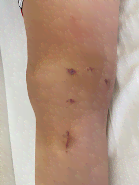 长期忽视：复发性髌骨脱位不手术可能导致的严重后果