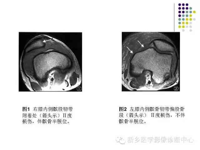 全面解读复发性髌骨脱位：症状、原因、诊断与治疗要点
