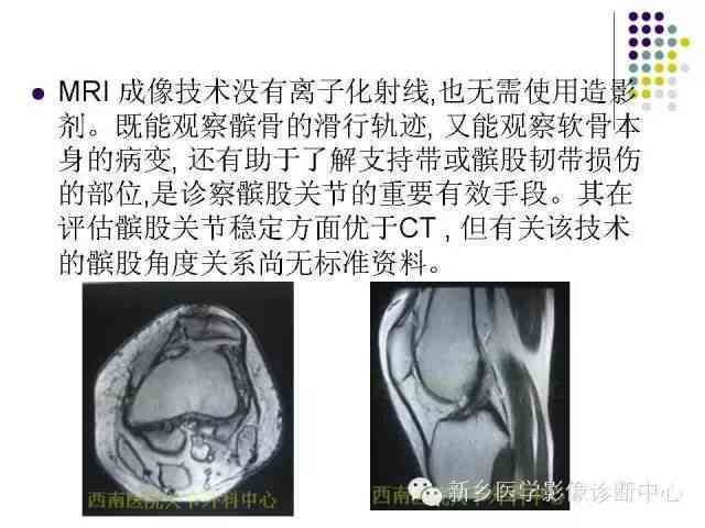全面解读复发性髌骨脱位：症状、原因、诊断与治疗要点
