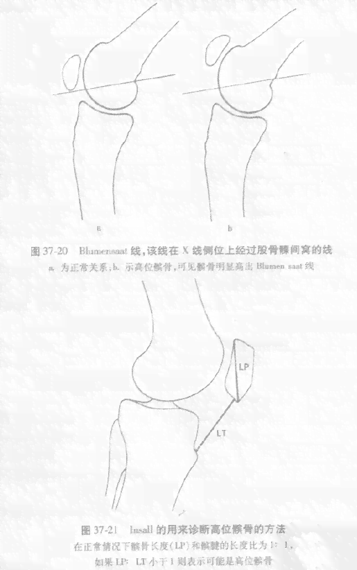 复发性髌骨脱位常见体征及症状解析与意外性质探讨