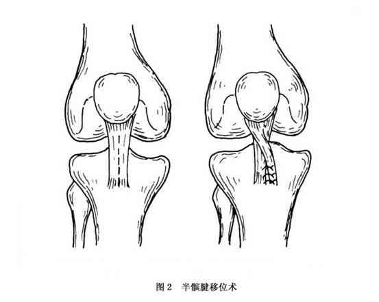 复发性髌骨脱位常见体征及症状解析与意外性质探讨