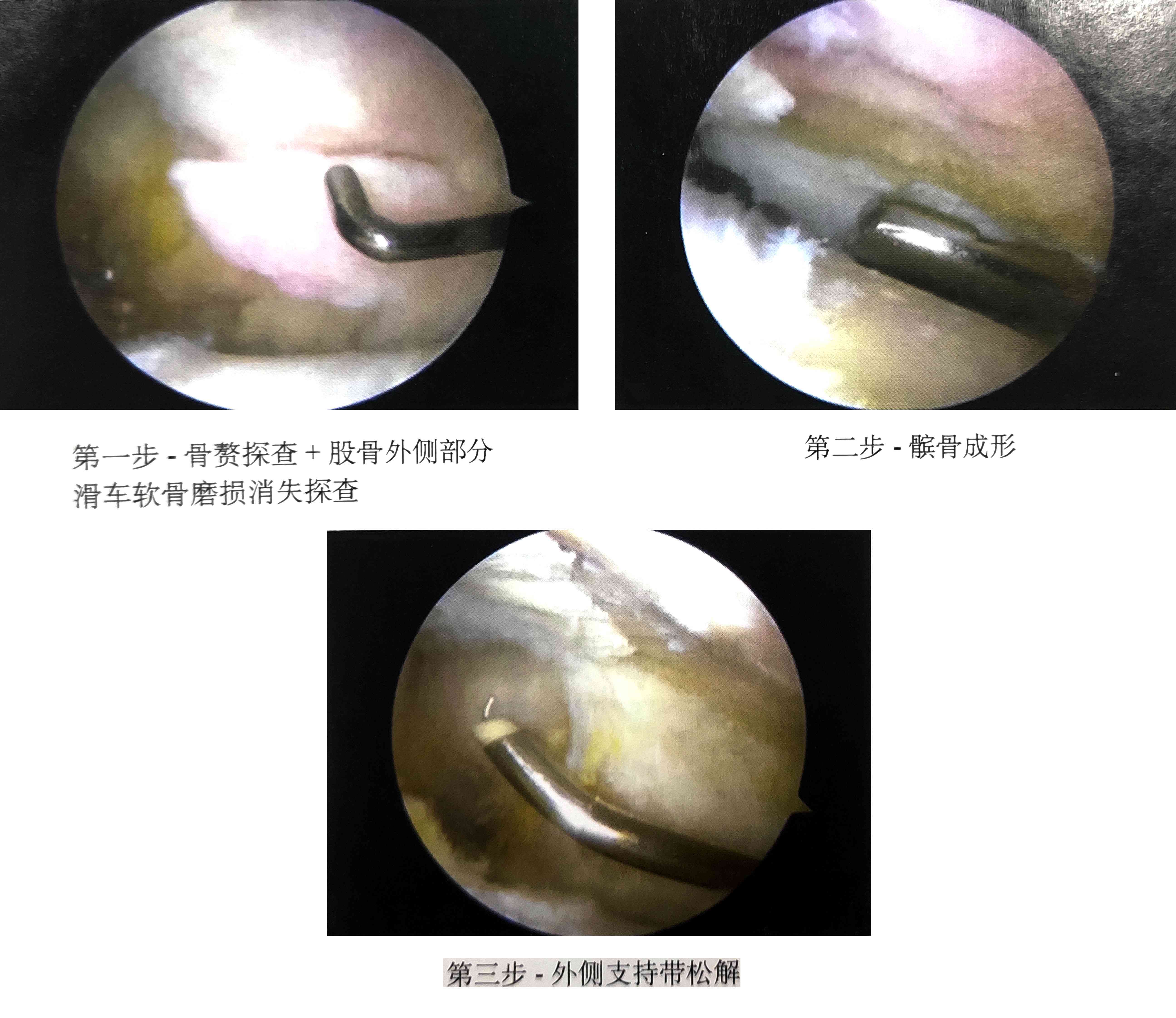 探讨复发性髌骨脱位：手术治疗是否为必要选择