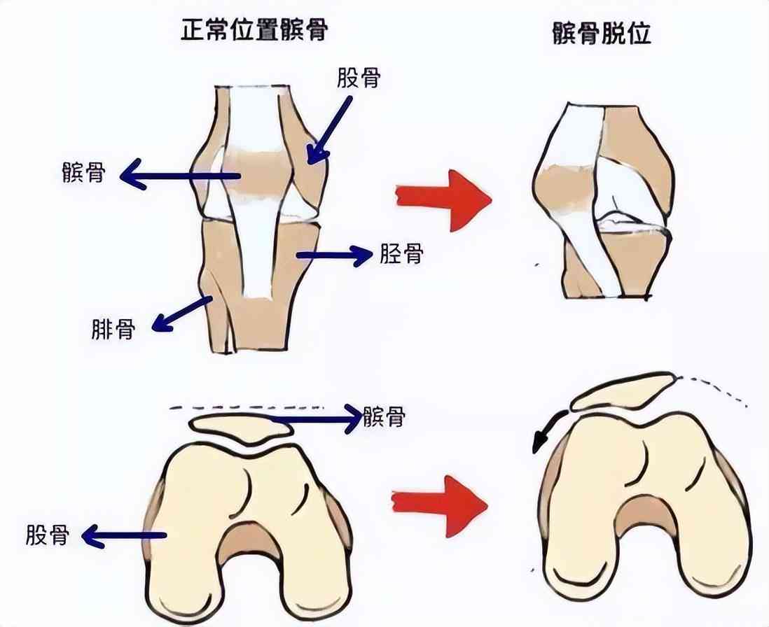 探讨复发性髌骨脱位：手术治疗是否为必要选择