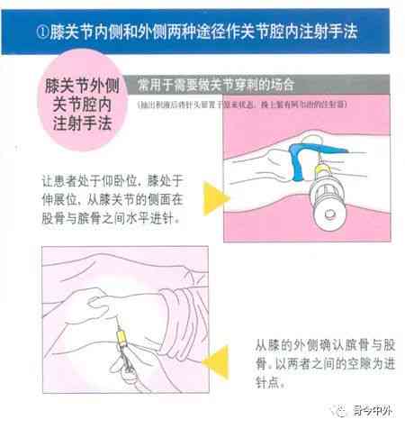 全面解析：复发性髌骨脱位的多种保守治疗策略与有效复方法